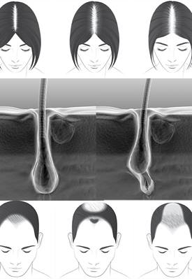 Hair Loss in Men and Women